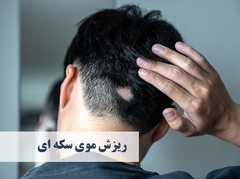 درمان ریزش موی سکه ای | دکتر حمیدرضا رهبر | هشتگرد | تهران | بهترین دکتر پوست و مو هشتگرد تهران