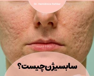 سابسیژن | ساب سیژن | مزوتراپی بدون جراحی | دکتر حمیدرضا رهبر | پزشک زیبایی هشتگرد | دکتر پوست و مو هشتگرد | تهران