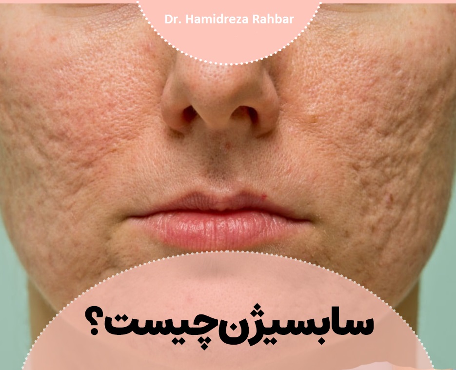 سابسیژن | ساب سیژن | مزوتراپی بدون جراحی | دکتر حمیدرضا رهبر | پزشک زیبایی هشتگرد | دکتر پوست و مو هشتگرد | تهران