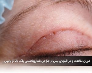 بلفاروپلاستی | دکتر رهبر | هشتگرد