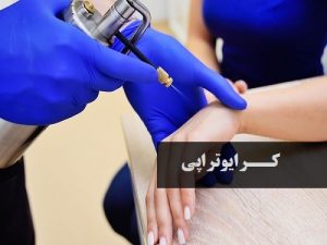 کرایوتراپی هشتگرد دکتر رهبر